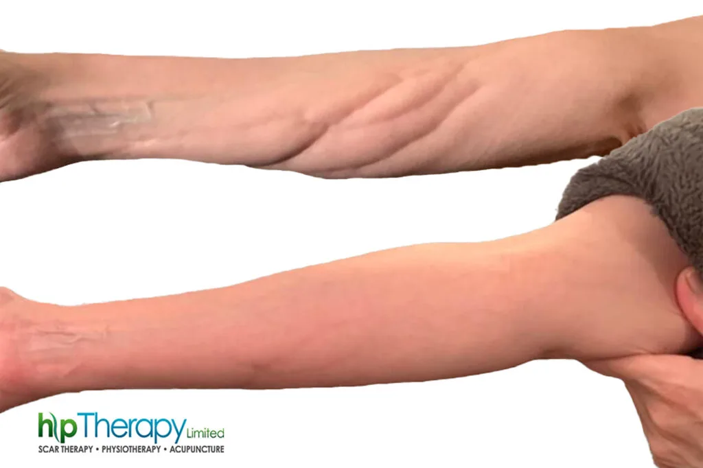 Utilizarea LymphaTouch în recuperarea după cancerul de sân